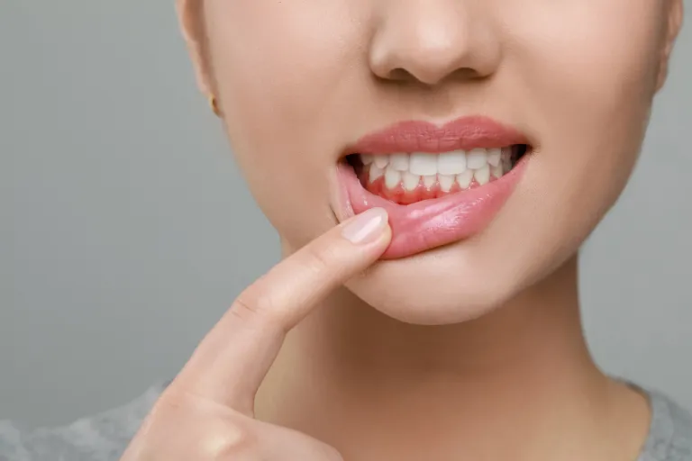 Leaky Gum: Understanding Gingival Permeability