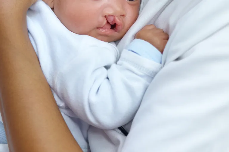 Understanding Cleft Lip and Palate: Diagnosis and Treatments